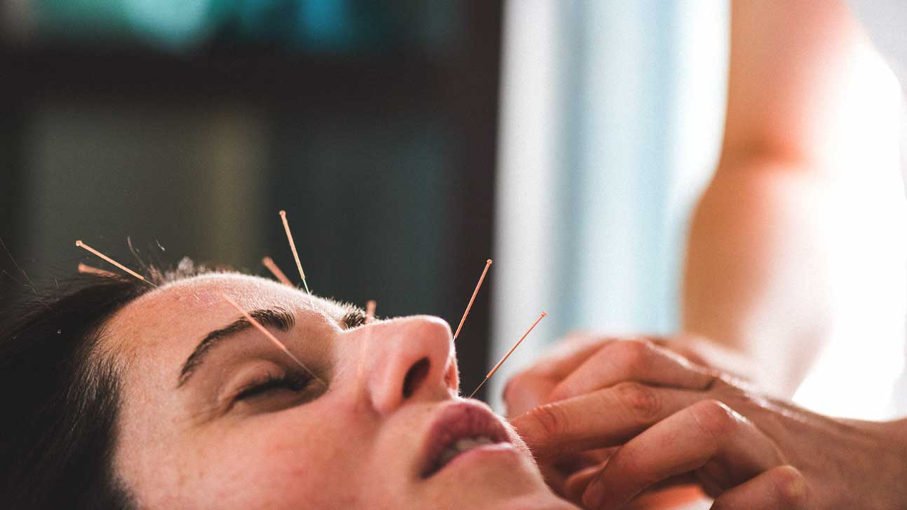 Acupuncture for Modern Life — Tiny Needles, Big Healing Power